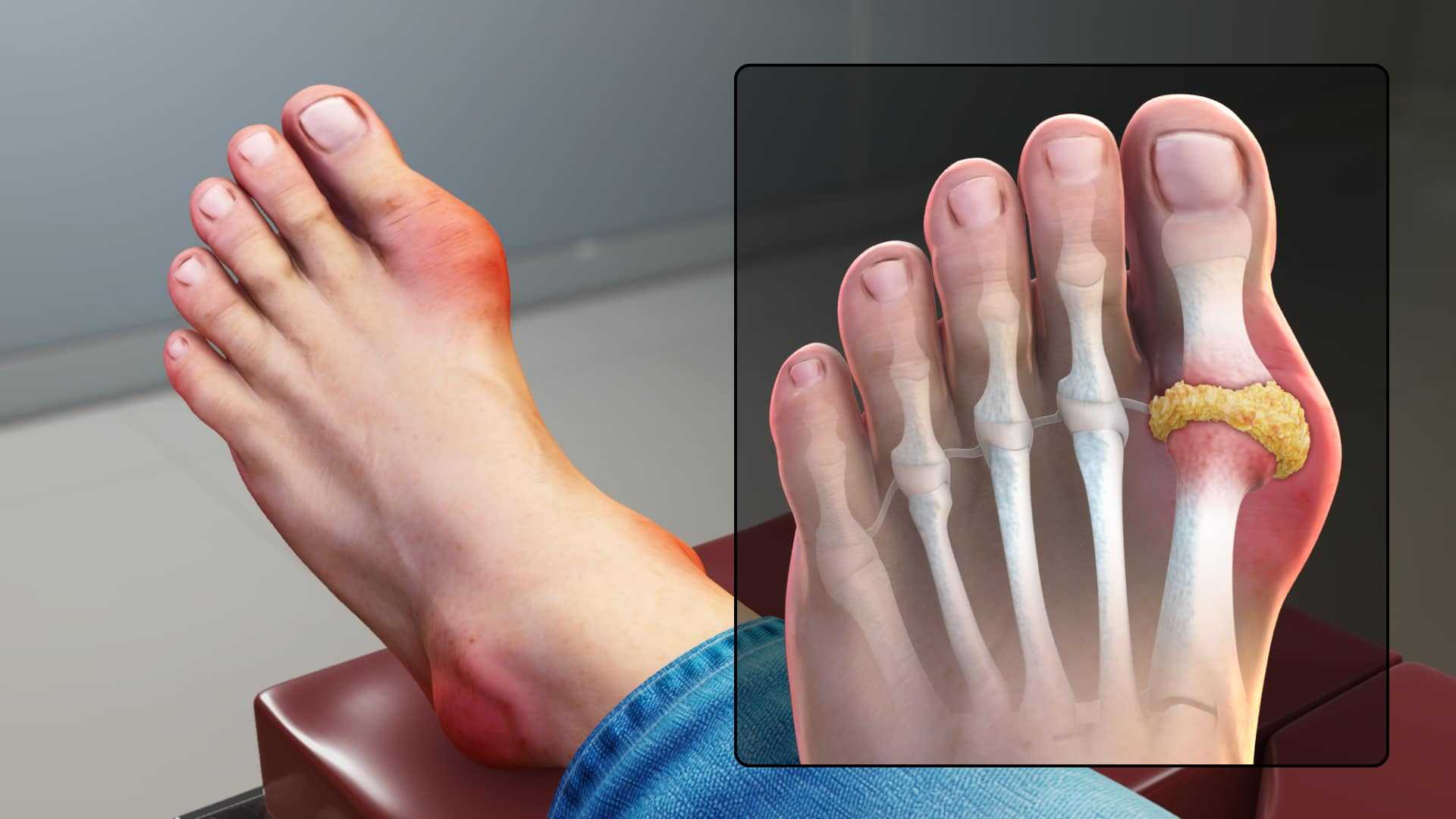 VA Disability for Gout