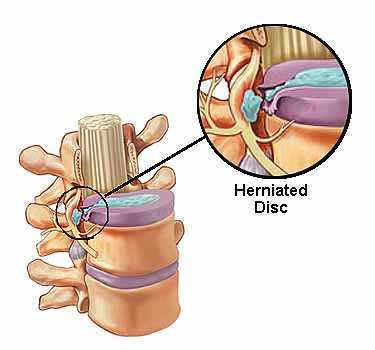 Herniated Disc VA Disability