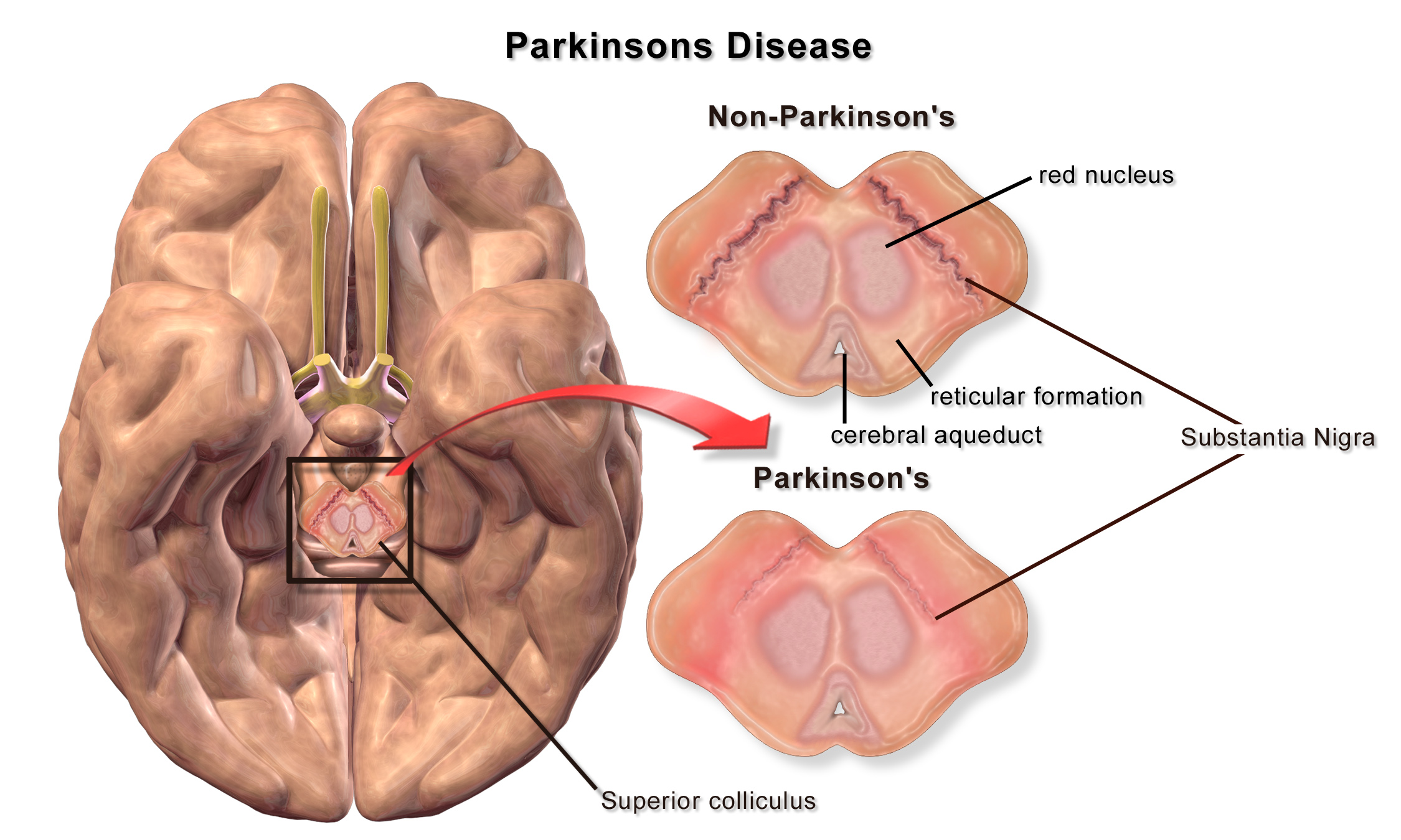 Parkinson’s Disease from Agent Orange Exposure