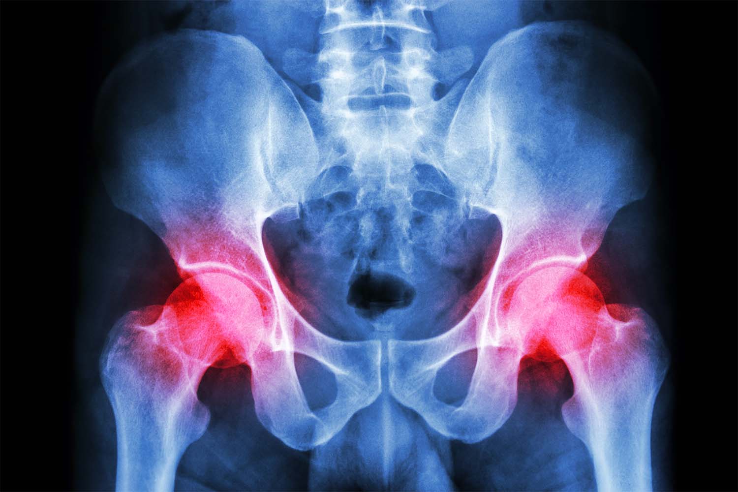 VA Disability Rating for Hip Pain Secondary to Back Injury