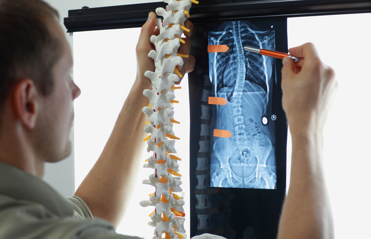 VA Disability Rating for Scoliosis in Veterans