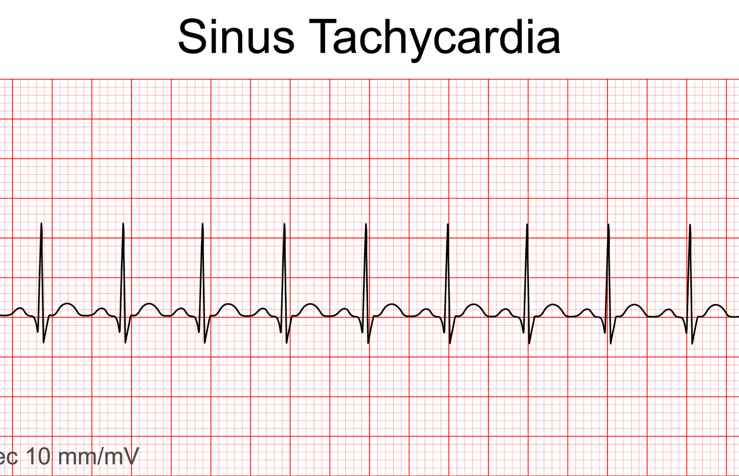 VA Disability Rating for Sinus Tachycardia